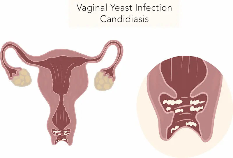 What Leads To Signs Of Vaginal Yeast Infection And